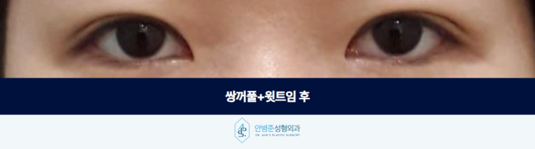 쌍꺼풀 윗트임 가짜 안검하수 판단하기 전에 알아야 할 것 관련 이미지 3