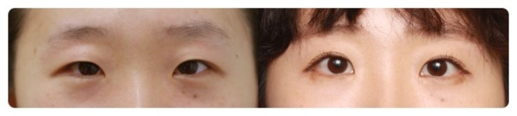안병준의 쌍꺼풀 지침서 08_한국인의 눈꺼풀 모양 관련 이미지 2