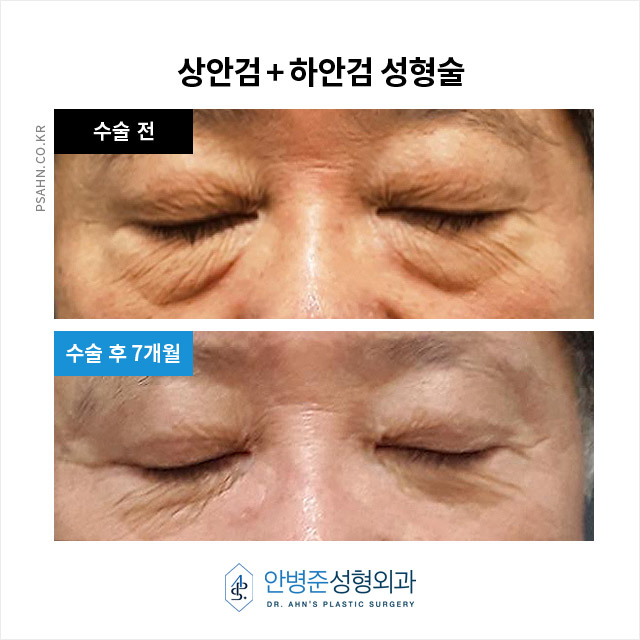[상안검,하안검]100세 시대, 남성 상하안검성형술의 새로운 관심 관련 이미지 12