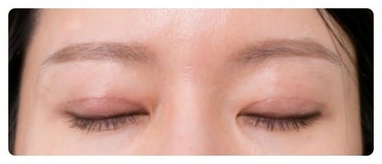 삼백안 교정 원인을 먼저 세심하게 봐야 합니다 관련 이미지 5