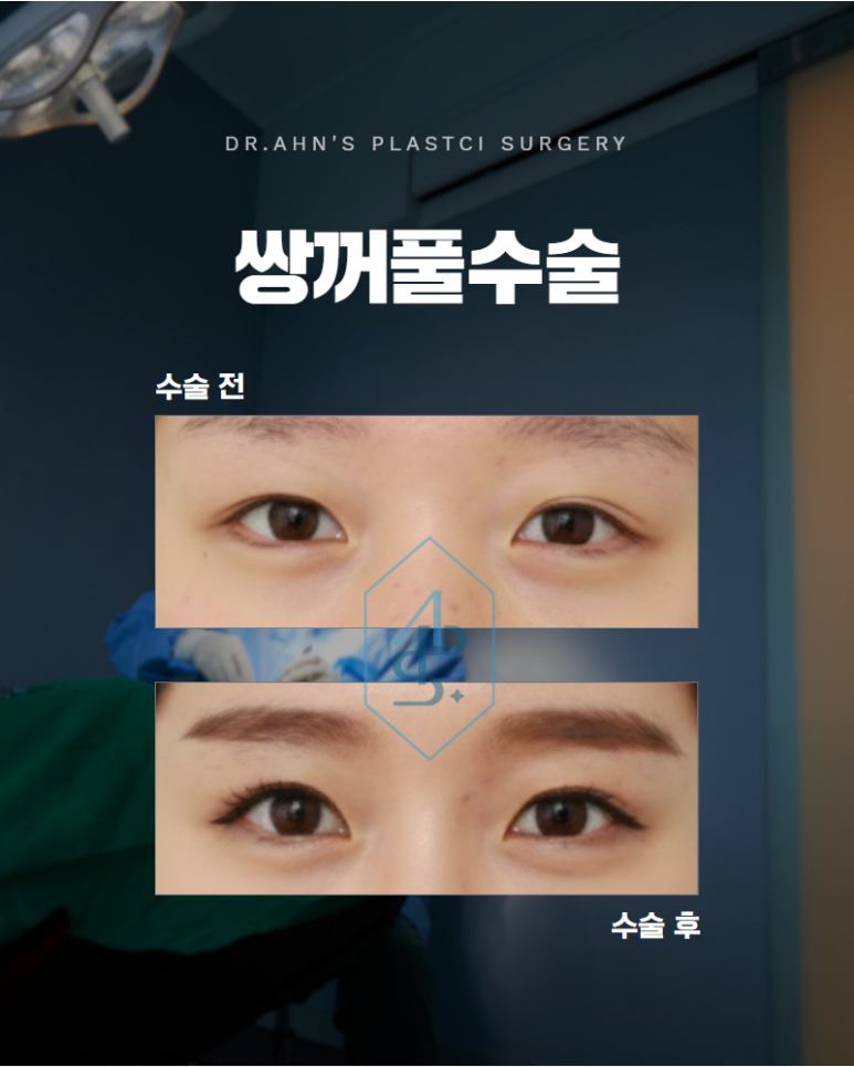 쌍꺼풀수술병원 선택 기본부터 충실한지 살펴보세요 관련 이미지 1