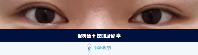 쌍꺼풀 눈매교정 조화롭게 자연스러움과 또렷함을 찾아서 관련 이미지 3