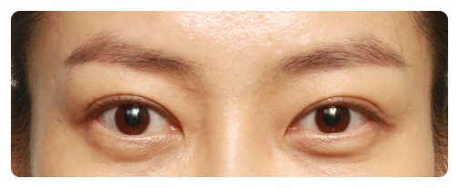 (재수술)높은라인의 쌍꺼풀 재수술      [안병준의 눈이야기] 관련 이미지 2