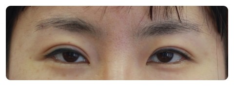 눈재수술 눈성형잘하는병원 시크릿성형외과 관련 이미지 2