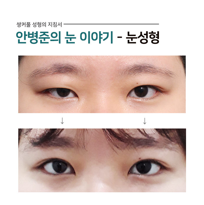 양쪽이 다른 짝눈의 안검하수 관련 이미지 1