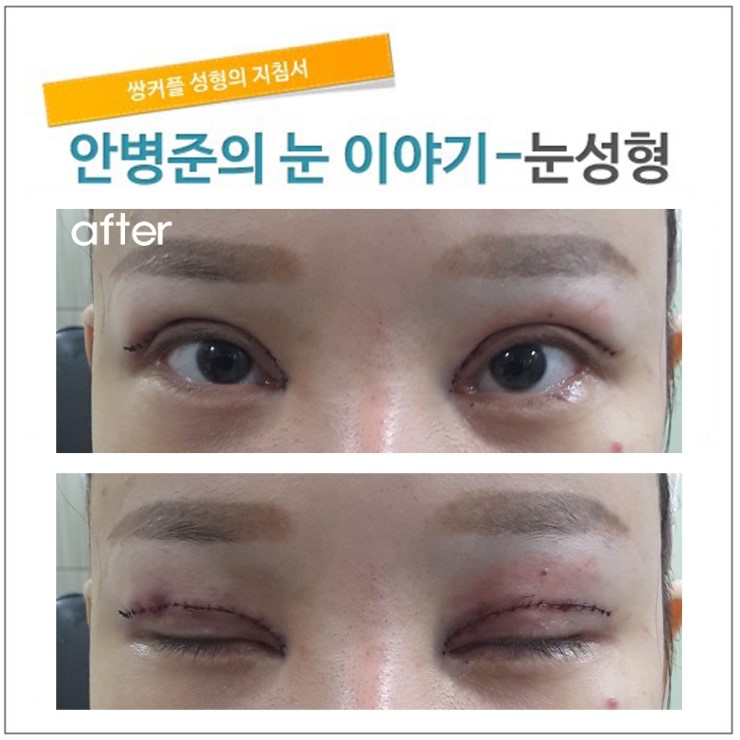 2번의 수술경력(중국환자)재수술 관련 이미지 2