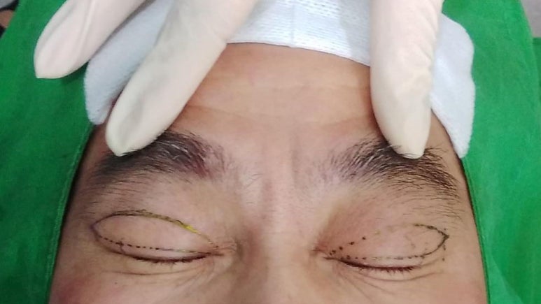 남자 쌍꺼풀 사례(짝눈,노인성눈,상안검성형술)#5~6 관련 이미지 3