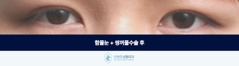 함몰눈 쌍꺼풀수술 꼼꼼한 분석으로 자연스러운 설계 및 개선까지 관련 이미지 3