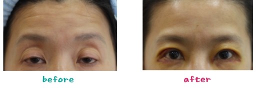 [안검하수(눈매교정)이란?] 관련 이미지 1