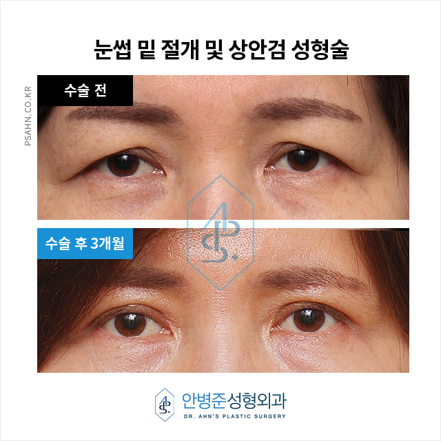 [강남역성형외과] 눈썹거상술? 눈썹밑절제술? 눈밑지방재배치? 관련 이미지 1