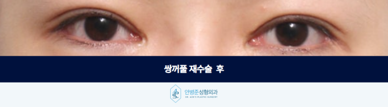 쌍꺼풀 재수술 여러 번 수술한 눈 어디서부터 다시 시작해야 할까요 관련 이미지 3