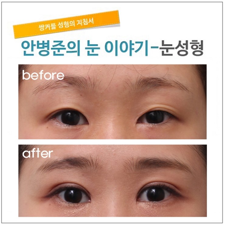 매몰법 수술후 풀린눈 재수술. 관련 이미지 1