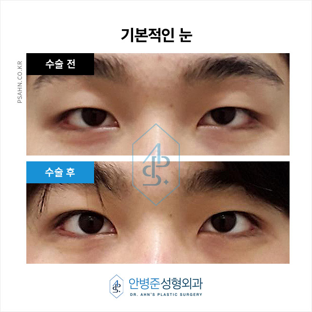 남성 쌍꺼풀 - 자연스러운 이미지 개선과 기능 회복 관련 이미지 2