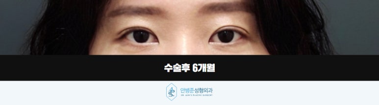 눈매교정 꺼진 눈은 교정하고, 쌍꺼풀은 더 자연스럽게 관련 이미지 3