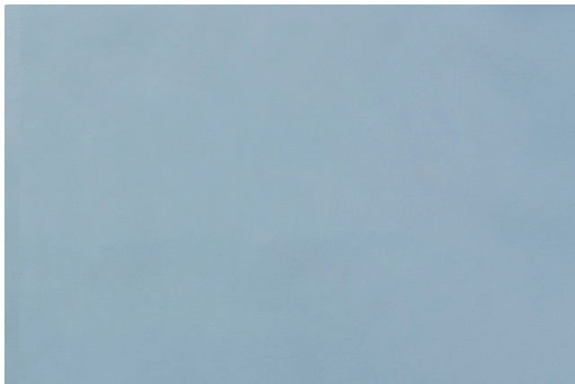 상안검성형술 처진 눈꺼풀로 고민이라면 확인해야 할 것 관련 이미지 9