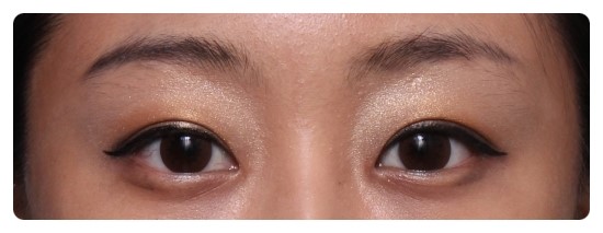 [안병준의 눈이야기]-안병준 성형외과 관련 이미지 6