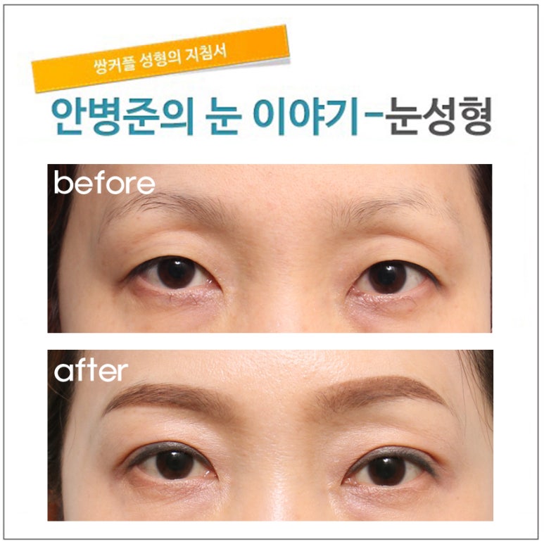 꺼진눈 지방이식(꺼진눈,지방이식,함몰눈,눈매교정,눈지방이식) 관련 이미지 1