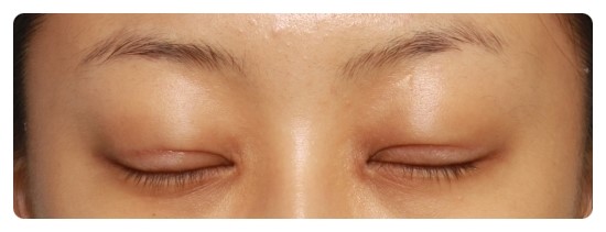 [안병준의 눈이야기]-안병준 성형외과 관련 이미지 5