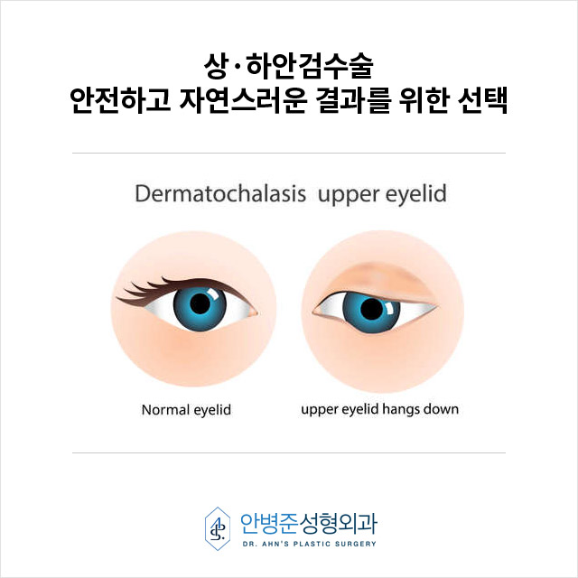 상&middot;하안검수술,안전하고 자연스러운 결과를 위한 선택 관련 이미지 1