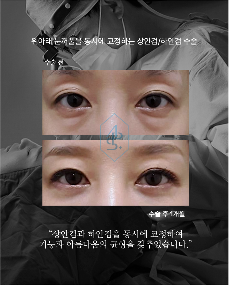 상하안검수술 필요한 순간 위아래 눈꺼풀을 함께 보는 이유 관련 이미지 7