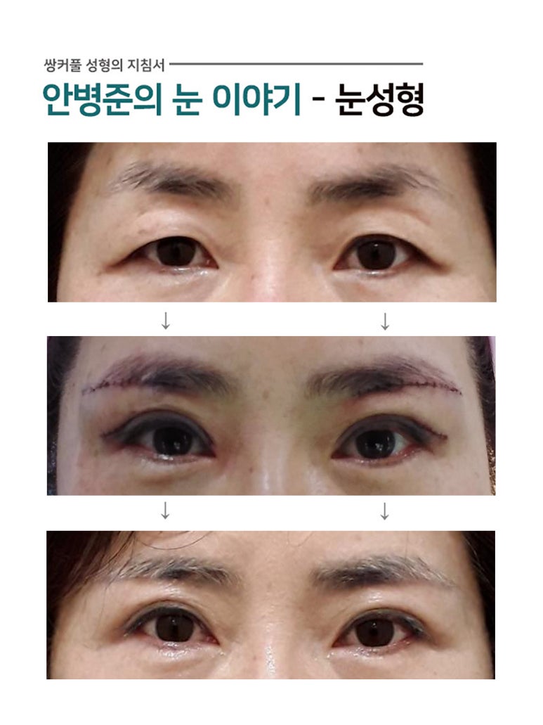 상안검성형술,눈썹밑절개 관련 이미지 1