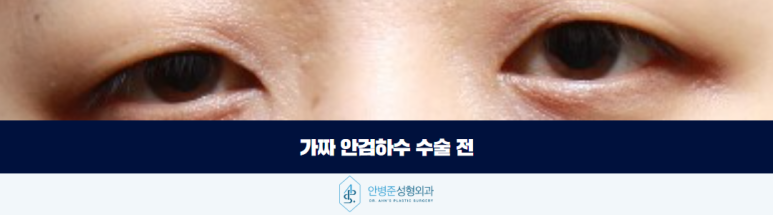 안검하수 눈매교정 가짜와 진짜를 구분해야 합니다 관련 이미지 3