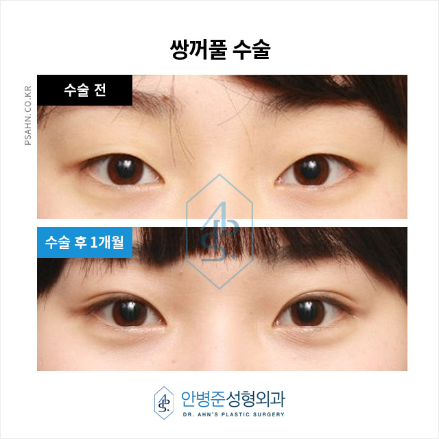 [강남성형외과] 쌍꺼풀 수술을 고민하시는 분들을 위해, 수술 전 준비부터 회복 과정까지~! 관련 이미지 5