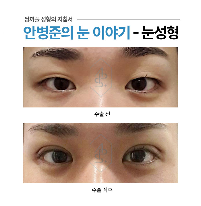 쌍꺼풀 수술에서 부기란? - 수술직후 붓기 사례 모음 관련 이미지 6