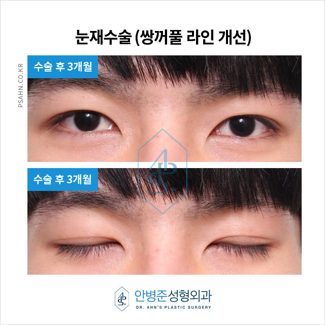 남성 쌍꺼풀재수술,자연스러운 라인과 문제 해결 방안 관련 이미지 4