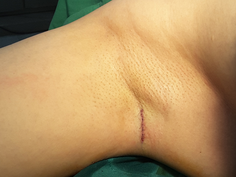 효과 좋은 지방이식 방법 관련 이미지 6