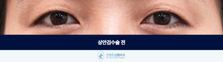 상안검수술 중년의 눈꺼풀 어떻게 접근해야 자연스러울까요 관련 이미지 2