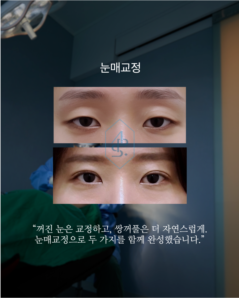 눈매교정 꺼진 눈은 교정하고, 쌍꺼풀은 더 자연스럽게 관련 이미지 1