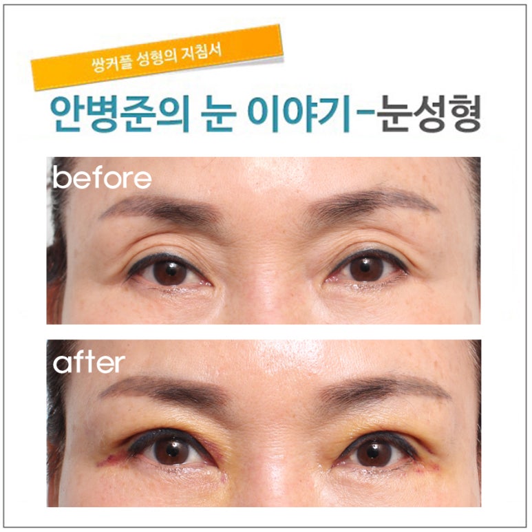 52세 여성으로 지방의 소실로 꺼진 눈꺼풀 관련 이미지 1