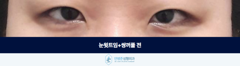 눈윗트임 쌍꺼풀 함께 진행하여 나타난 시너지 효과 관련 이미지 2