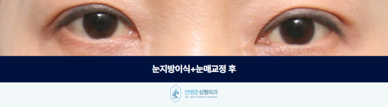 눈지방이식 꺼진 눈꺼풀 자연스럽게 채울 수 있을까요 관련 이미지 3