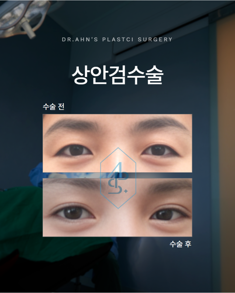 상안검수술 중년의 눈꺼풀 어떻게 접근해야 자연스러울까요 관련 이미지 1
