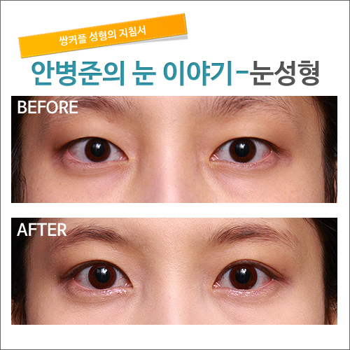 쌍꺼풀이란?_시크릿 성형외과 안병준의 쌍꺼풀 지침서 관련 이미지 2