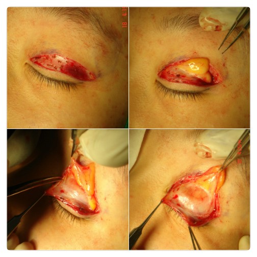 -쌍꺼풀 수술은 왜 하려하는가??-        [안병준의 눈이야기] 관련 이미지 3