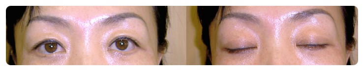 쌍꺼풀 라인 고정 자연스러움을 이끌어내는 기준 관련 이미지 4