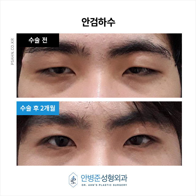 [남자눈성형] 눈의 피로를 덜고 밝은 인상을 되찾는 방법 중 하나! 관련 이미지 7