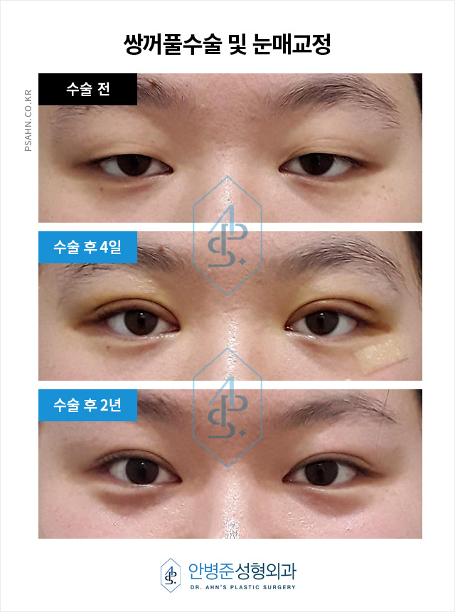 [방배역성형외과] 쌍꺼풀수과 눈매교정술 수술사례 관련 이미지 1