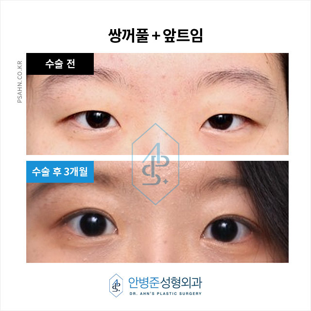 눈꺼풀의 지방과 근육을 적당량 제거하는 두툼한 눈 관련 이미지 1