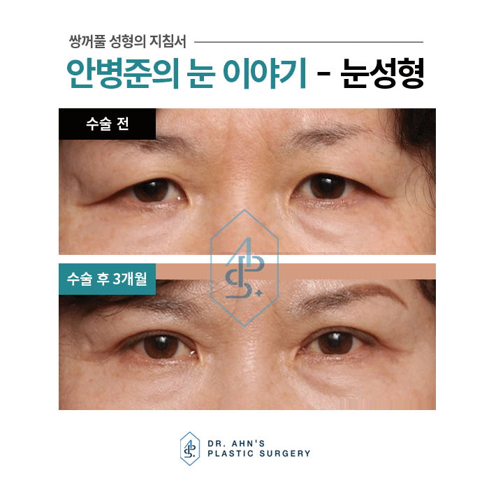처진눈의 기능 및 미용 안검 상안검수술 3개월 사례 관련 이미지 3