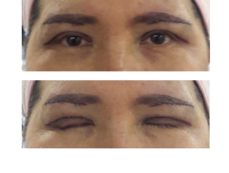 상안검성형술과 눈썹밑 절개술 관련 이미지 2