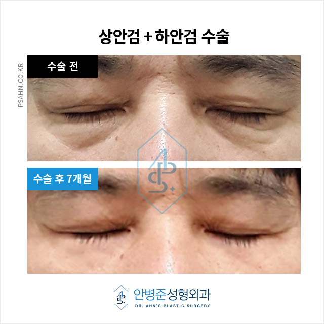 [강남역성형외과] 상안검과 하안검 수술: 남성을 위한 개선 방법 관련 이미지 3