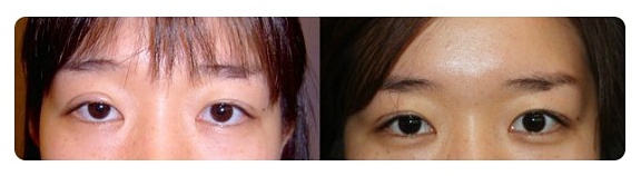 쌍꺼풀 라인크기 두껍게 한다고 정답은 아닙니다 관련 이미지 4