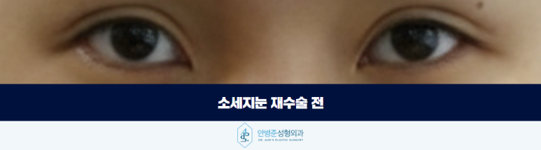 소세지눈 재수술 부기와 구분해야 하는 이유 관련 이미지 2