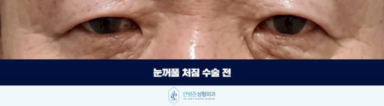 눈꺼풀 처짐 이마 거상이 정답일까요 관련 이미지 3