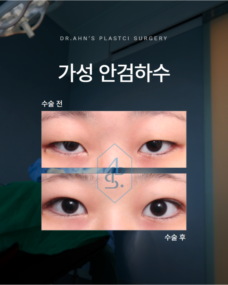 가성 안검하수 잘 구분되지 않지만 수술 방향은 전혀 달라야 합니다 관련 이미지 1