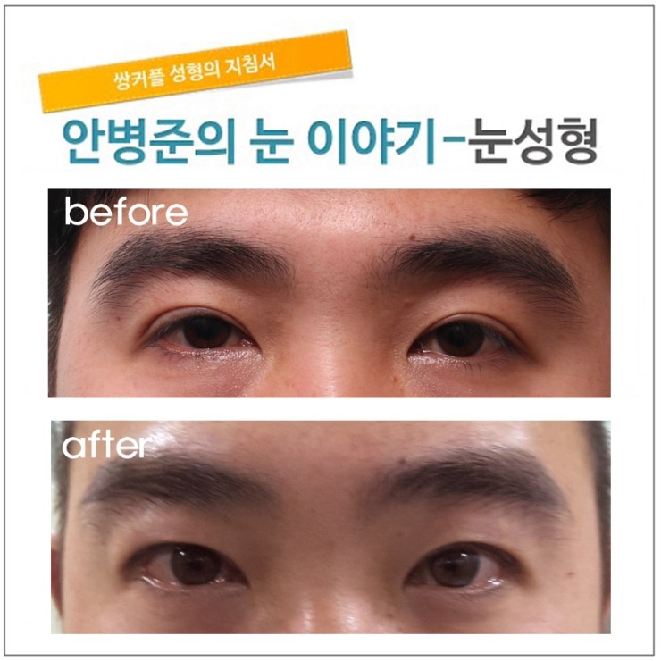 high fold(큰 쌍꺼풀)줄이기.(쌀꺼풀라인줄이기) 관련 이미지 2